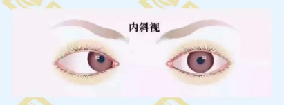 什么是調(diào)節(jié)性內(nèi)斜視？