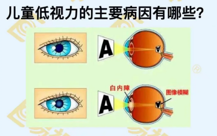 兒童低視力主要病因有哪些？