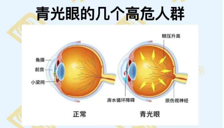 青光眼的幾個(gè)高危人群？