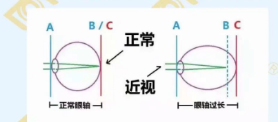 哪個年齡近視度數(shù)最容易增長？