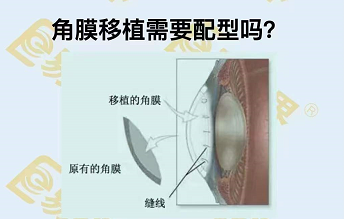 角膜移植需要配型嗎？